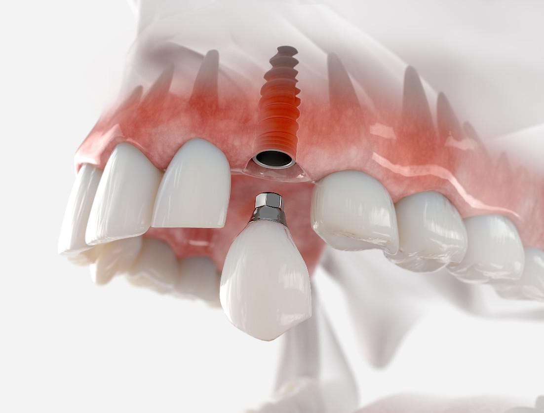 Dental Implants Arlington, VA